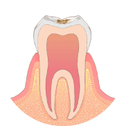 歯の表面に虫歯ができます
