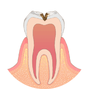 虫歯が神経に近くなり、冷たいものがしみます