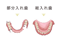 保険診療の部分入れ歯と総入れ歯