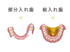 自由診療の部分入れ歯と総入れ歯