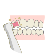 歯のクリーニングと自宅での使用法説明